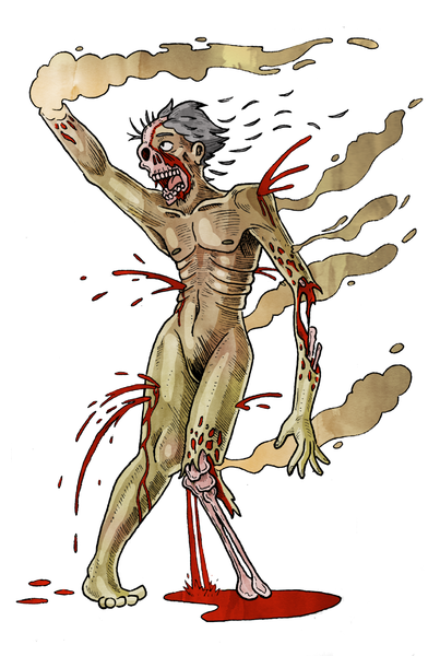 File:Necrotizing Fascinitis.png